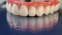 Dental Implants