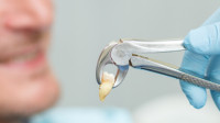 Tooth Extractions