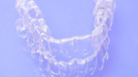 Clear Aligners