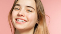 Orthodontics for Teens