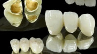 PFM Crowns