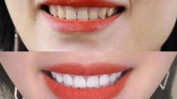 Veneers