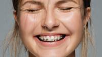 Braces