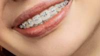 Braces for Adults, Kids and Teens