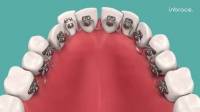 InSmile Lingual Braces For Adults, Kids and Teens